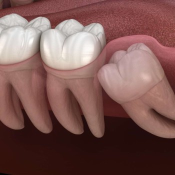affordable wisdom tooth extraction